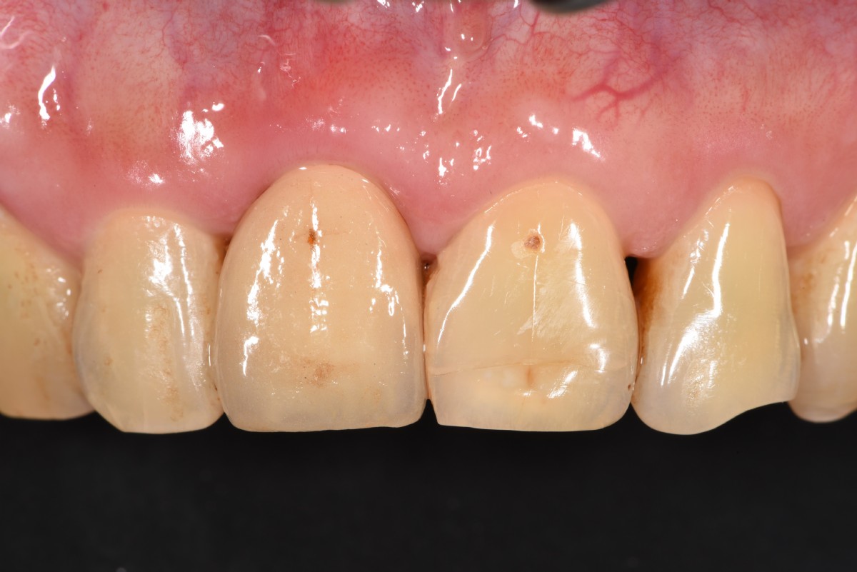 植牙案例｜植牙牙根跟骨肉修復