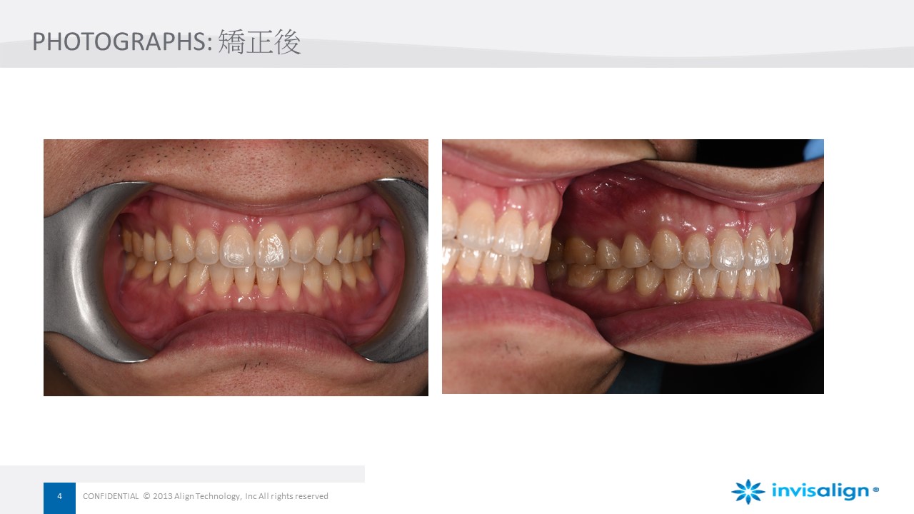 牙齒矯正｜隱形矯正