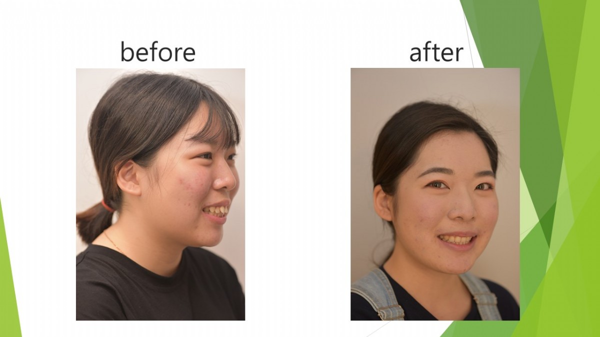 牙齒矯正｜暴牙矯正