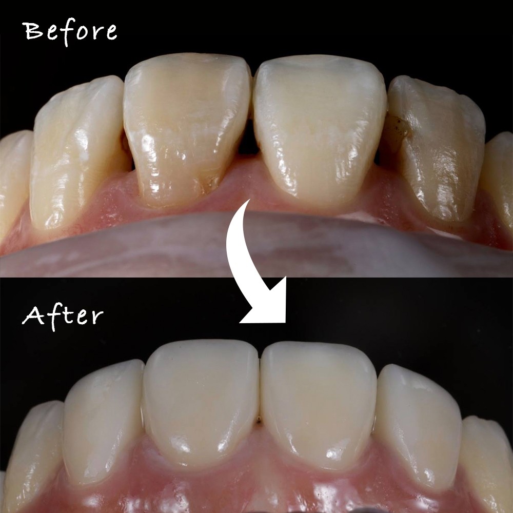 瓷牙貼片
