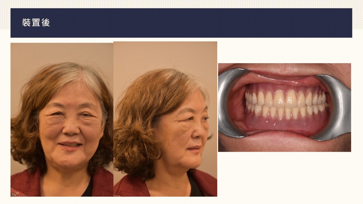 鈕扣式植牙｜鈕扣式植牙