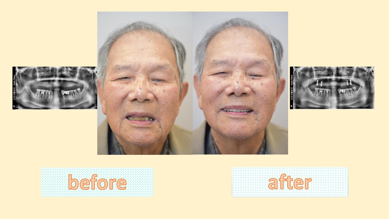 鈕扣式植牙｜鈕扣式植牙