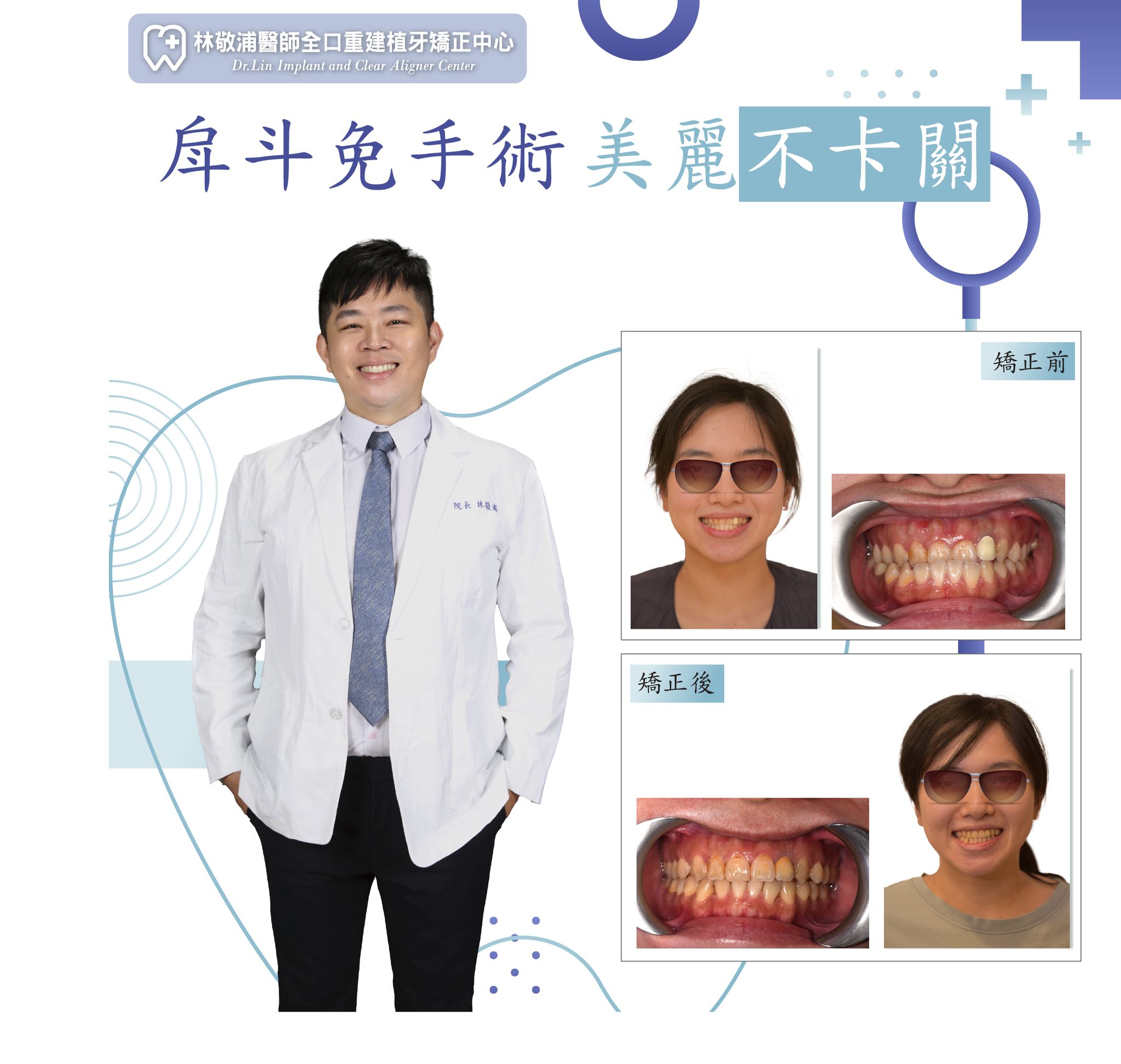 牙齒矯正｜不手術矯正戽斗