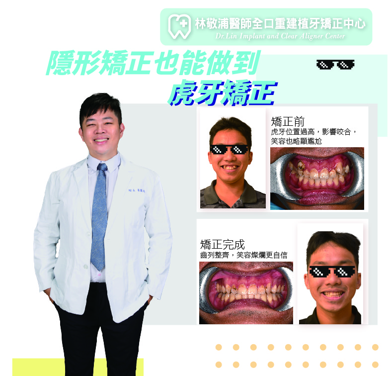 牙齒矯正｜隱適美拔牙矯正虎牙