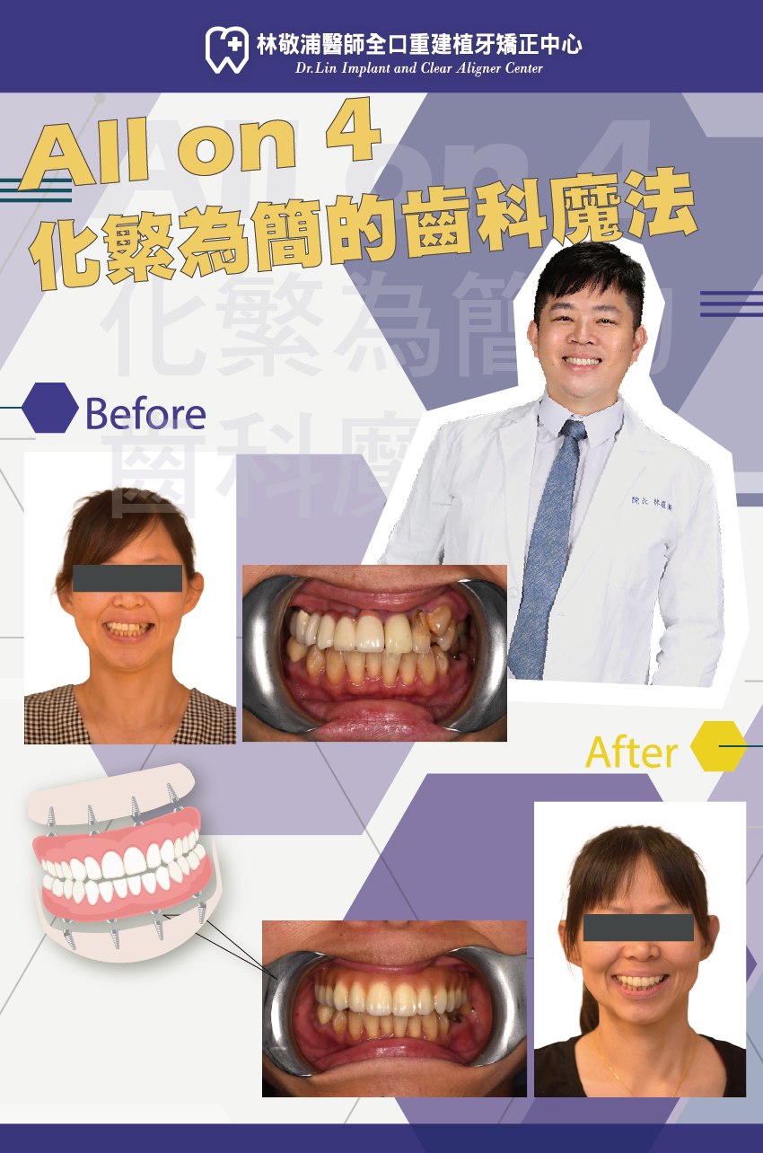 All on 4｜牙齒凌亂矯正