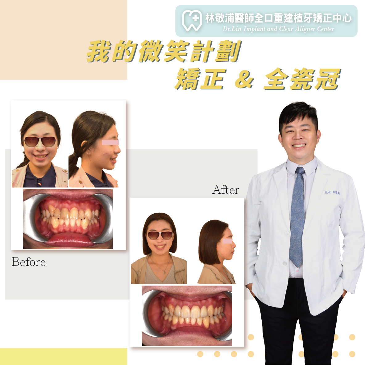 全瓷冠｜虎牙矯正