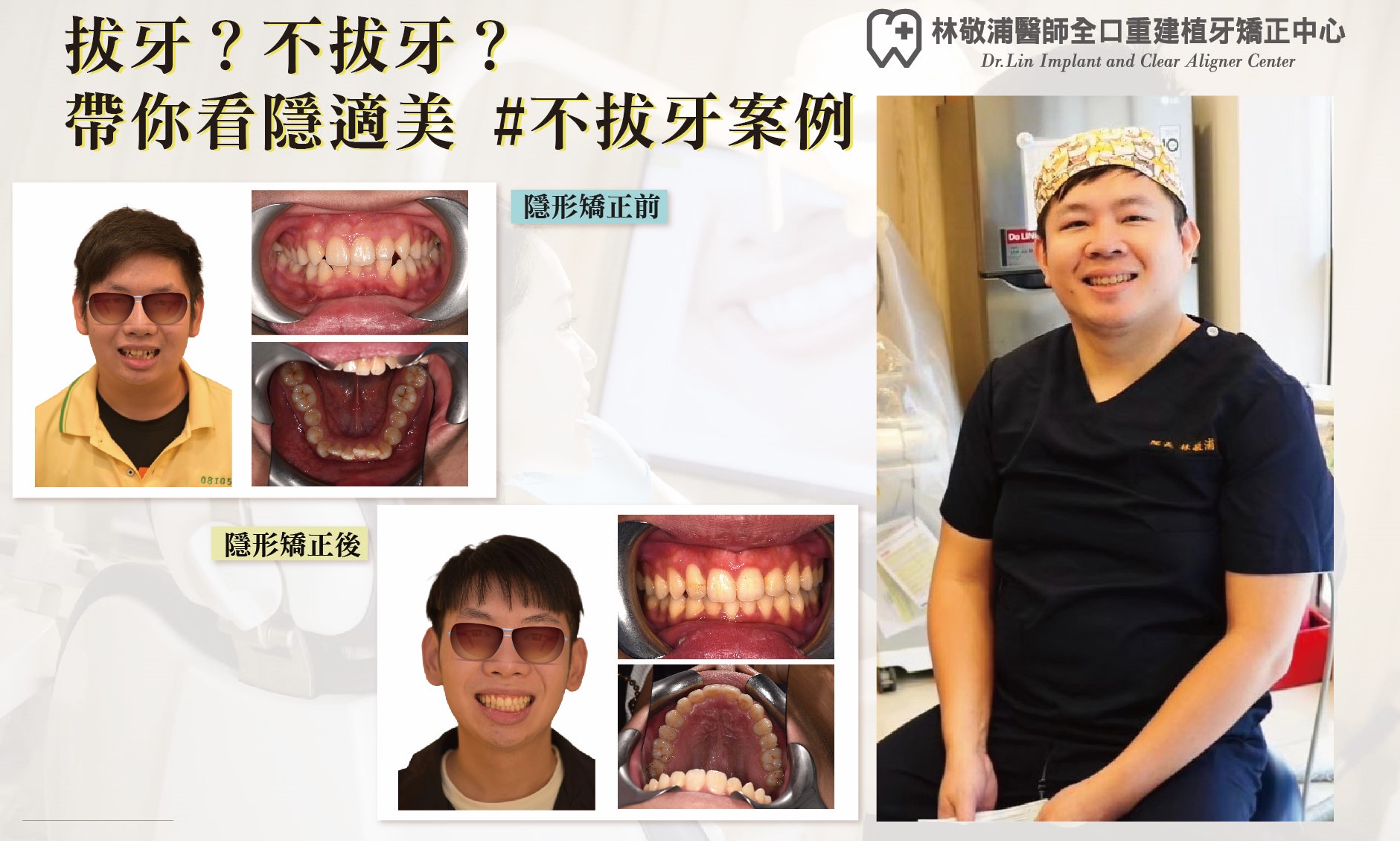 牙齒矯正｜不拔牙矯正