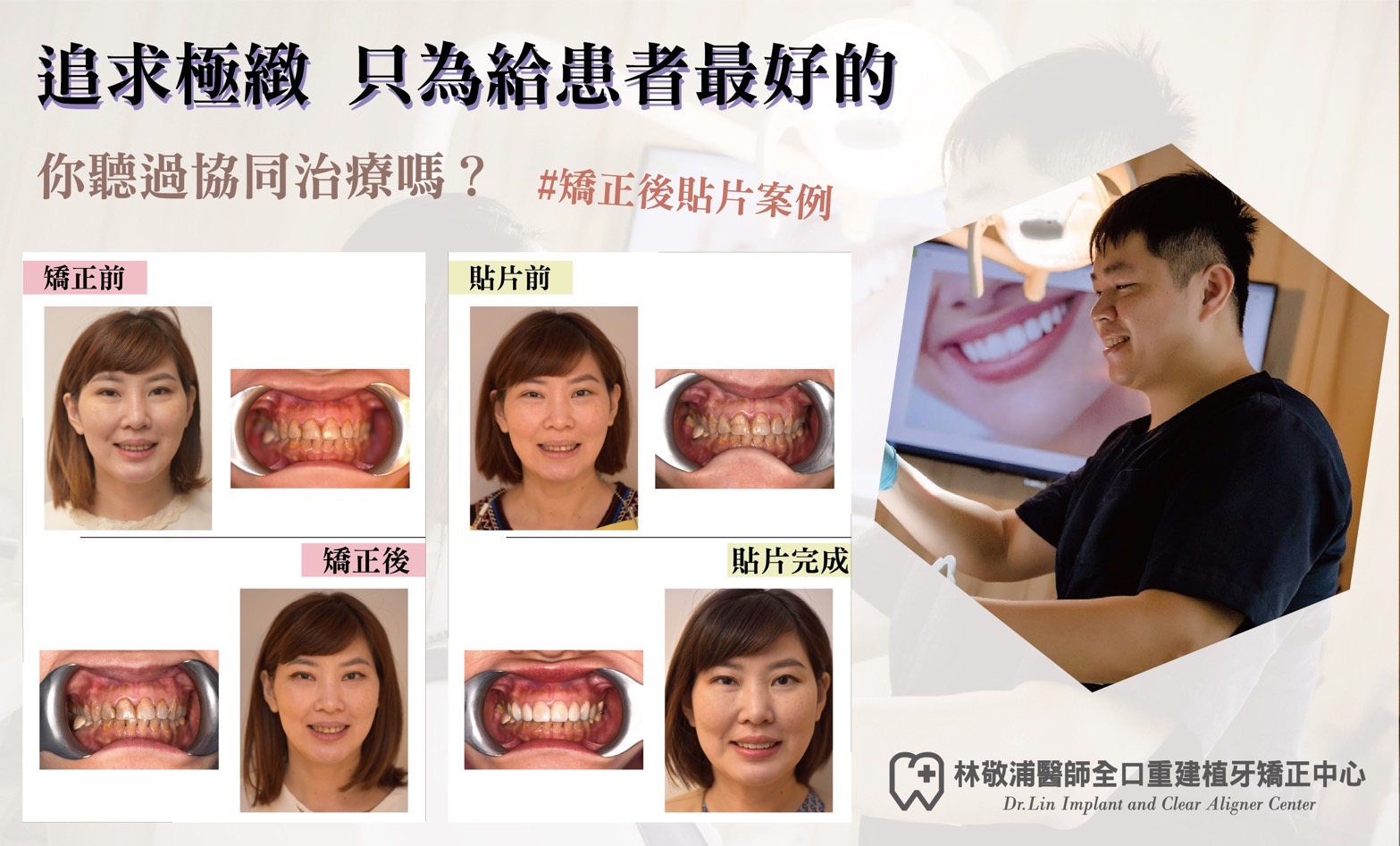 隱形矯正+全瓷貼片