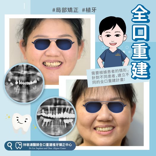 全口重建｜局部矯正+假牙+植牙