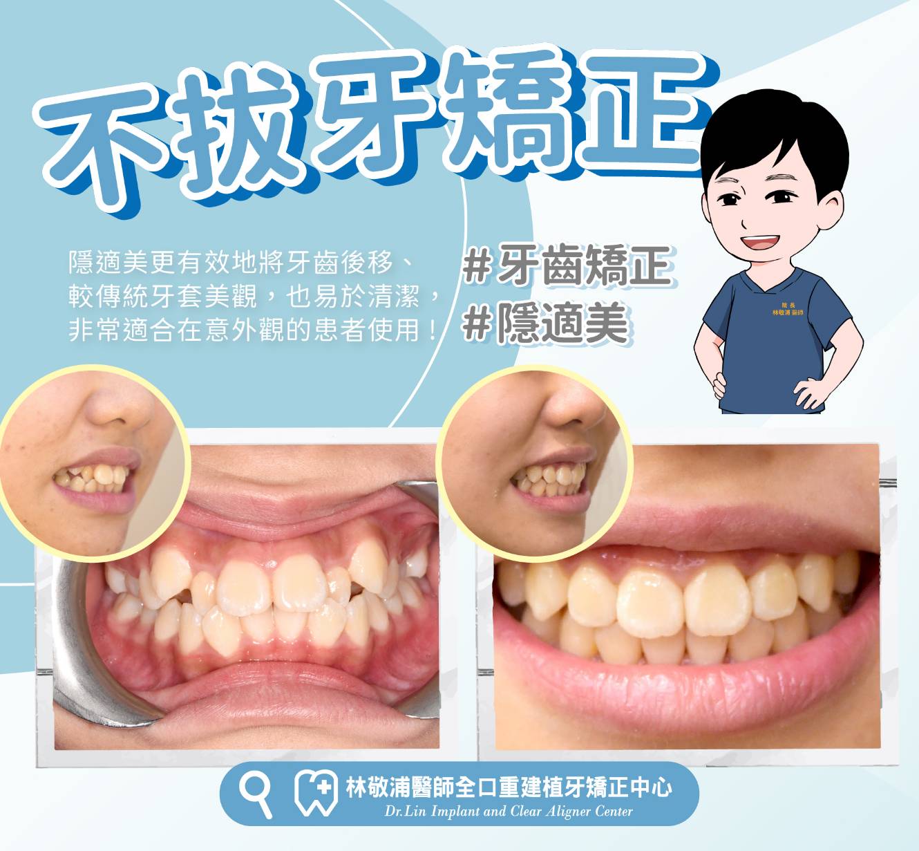 隱適美｜不拔牙矯正