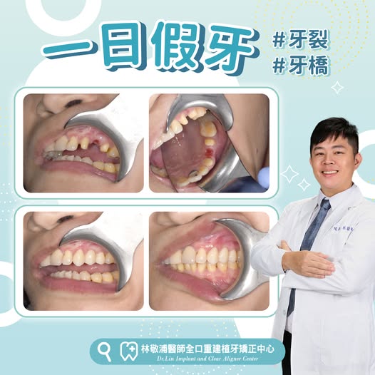 一日假牙｜牙橋