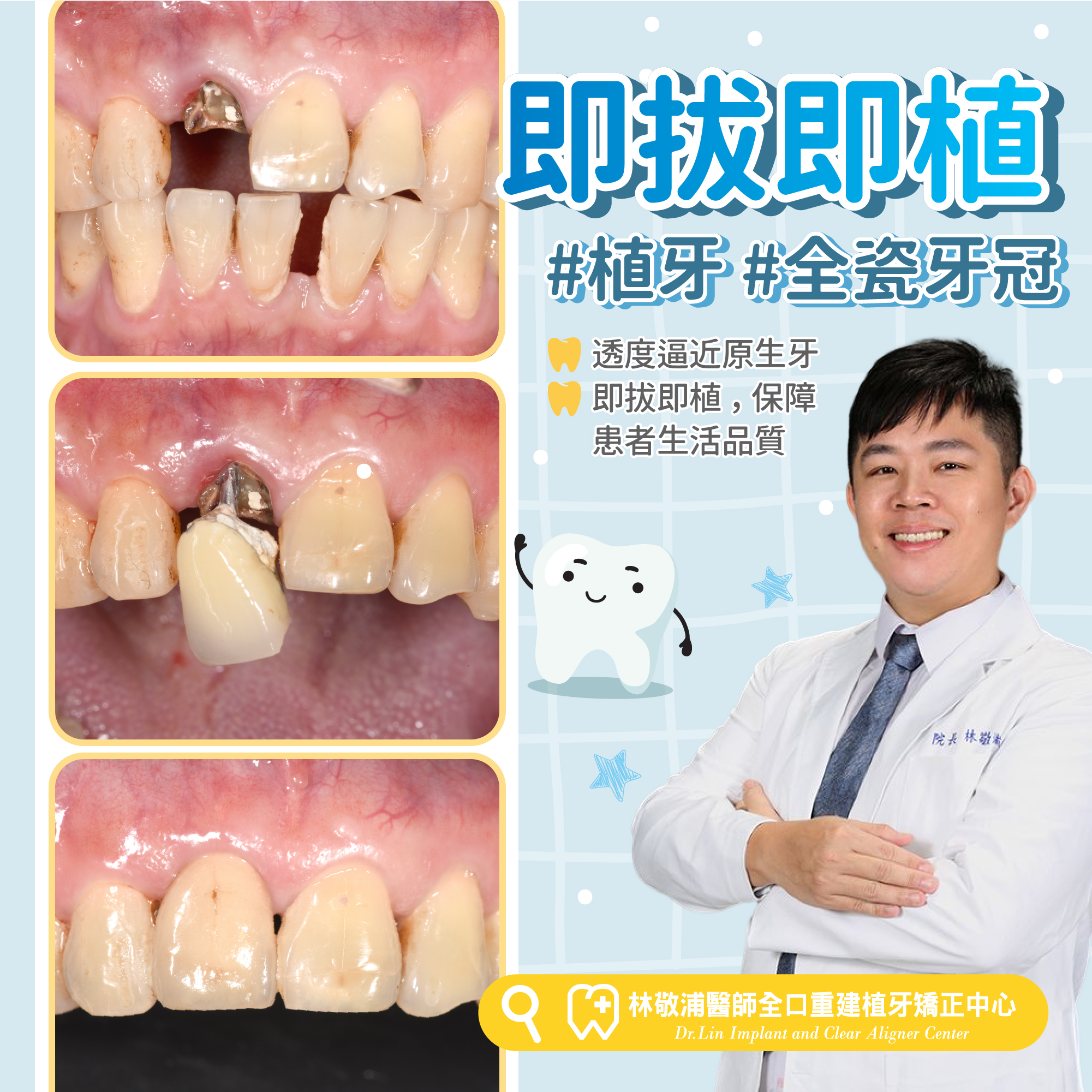 植牙案例｜即拔即植