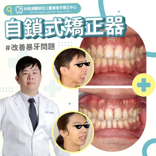 自鎖式矯正器｜改善暴牙