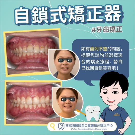 自鎖式矯正器｜牙齒矯正 