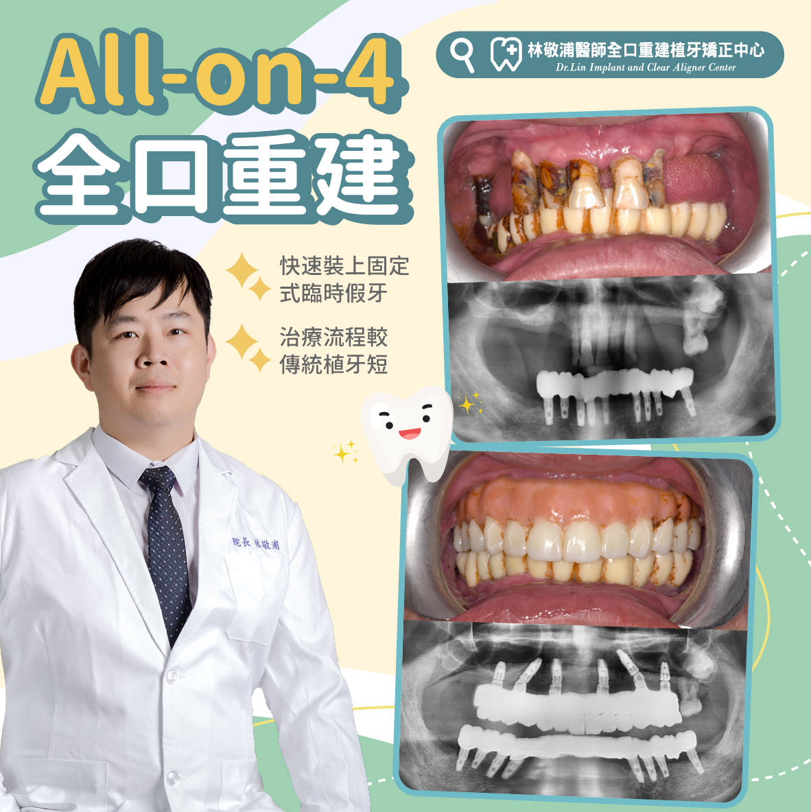 All ON 4｜全口重建