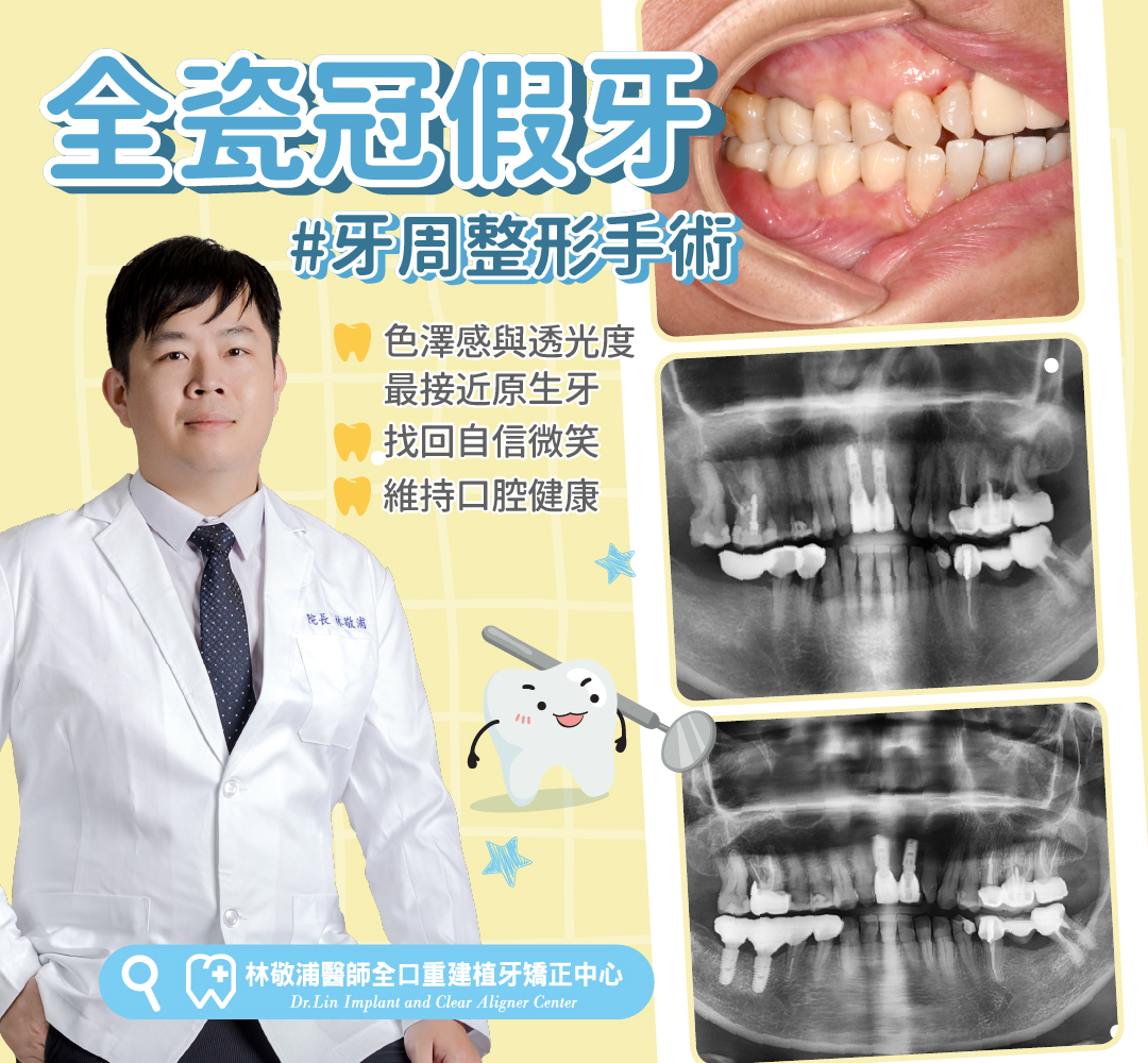 全瓷冠假牙｜牙周整形手術