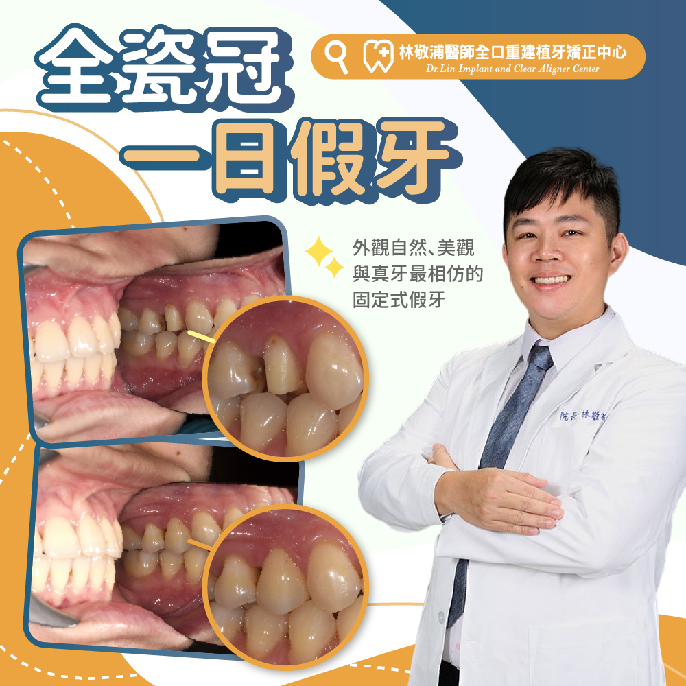 全瓷冠｜一日假牙