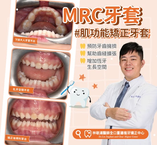 MRC牙套｜預防擁擠齒列