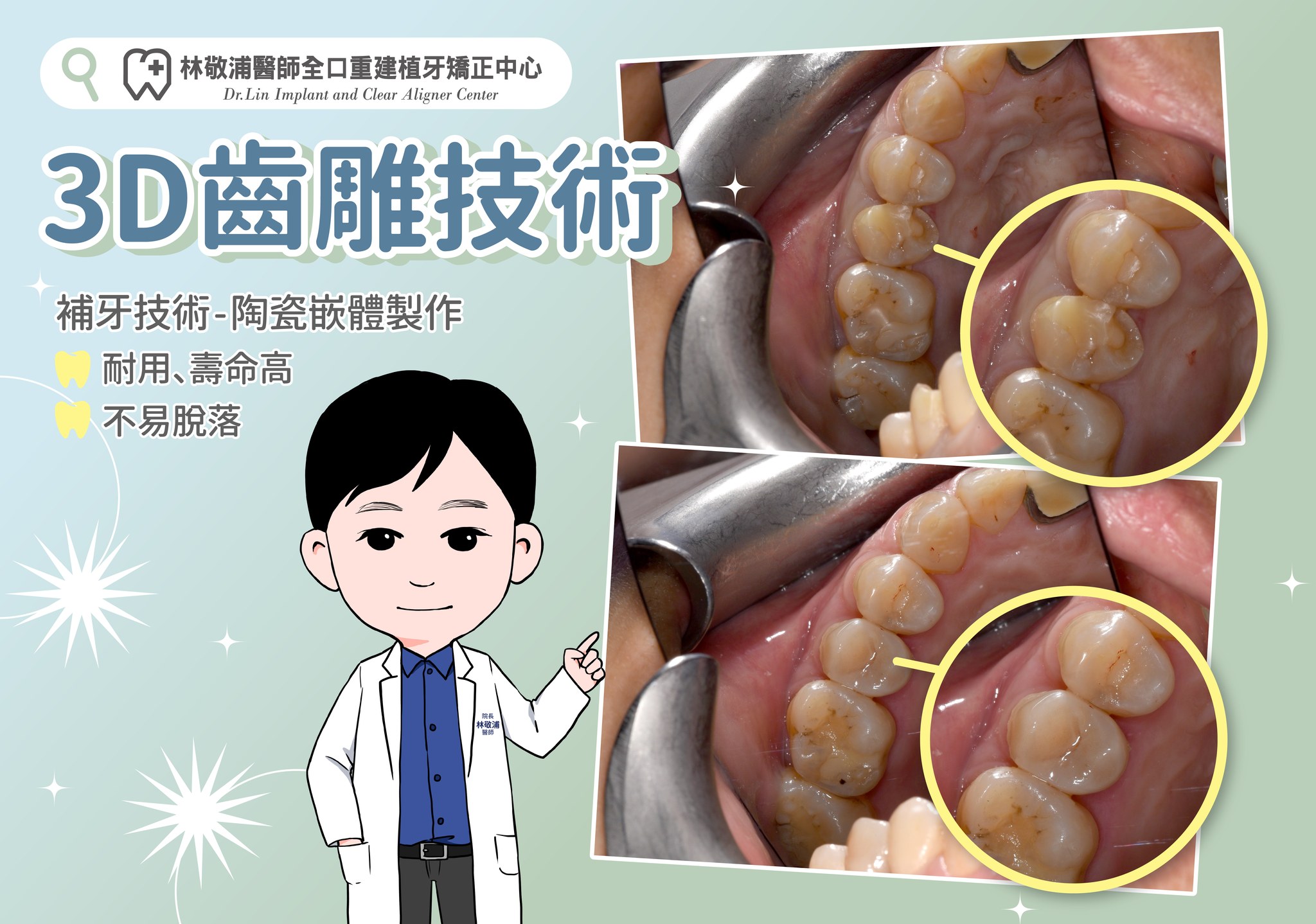 3D齒雕｜一日齒雕