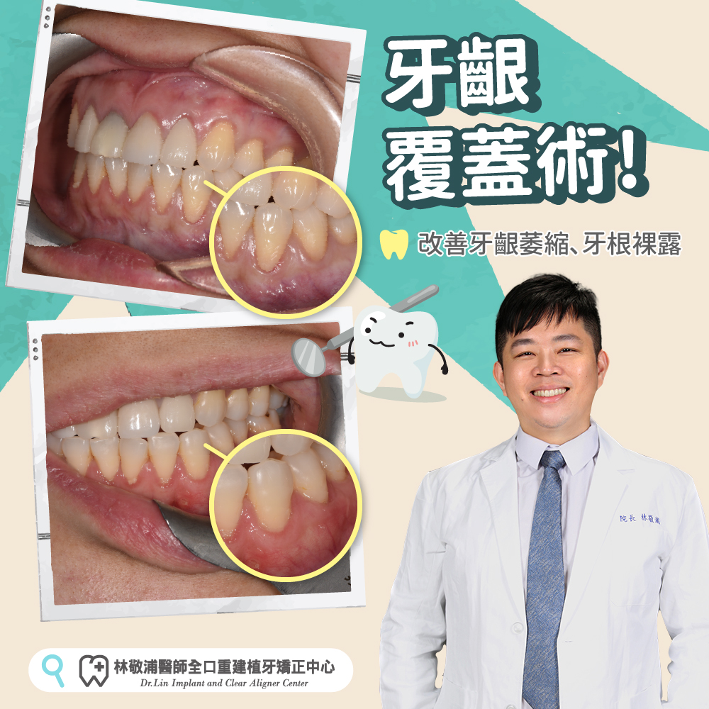 牙齦覆蓋術｜改善牙齦萎縮、牙根裸露