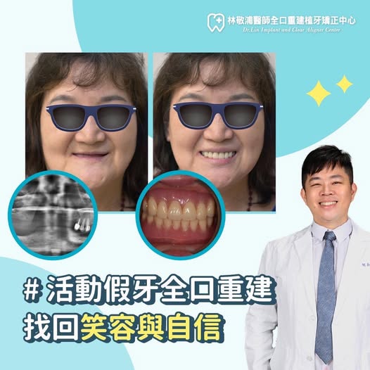 全口重建｜活動假牙