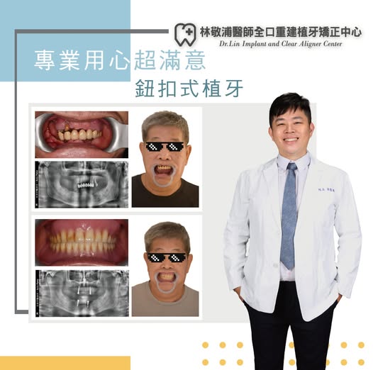 鈕扣式植牙｜鈕扣式植牙