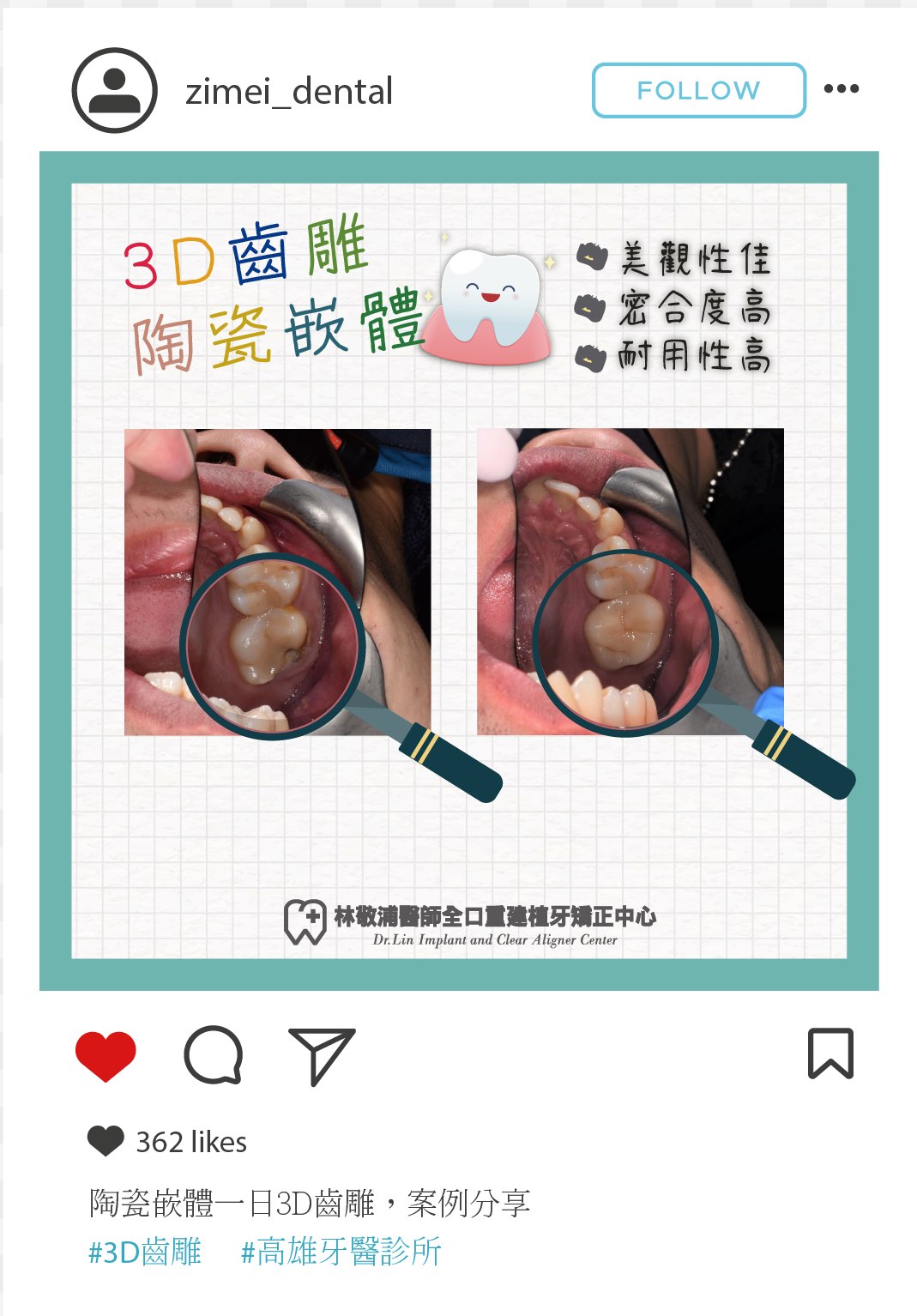 3D齒雕｜陶瓷嵌體修復