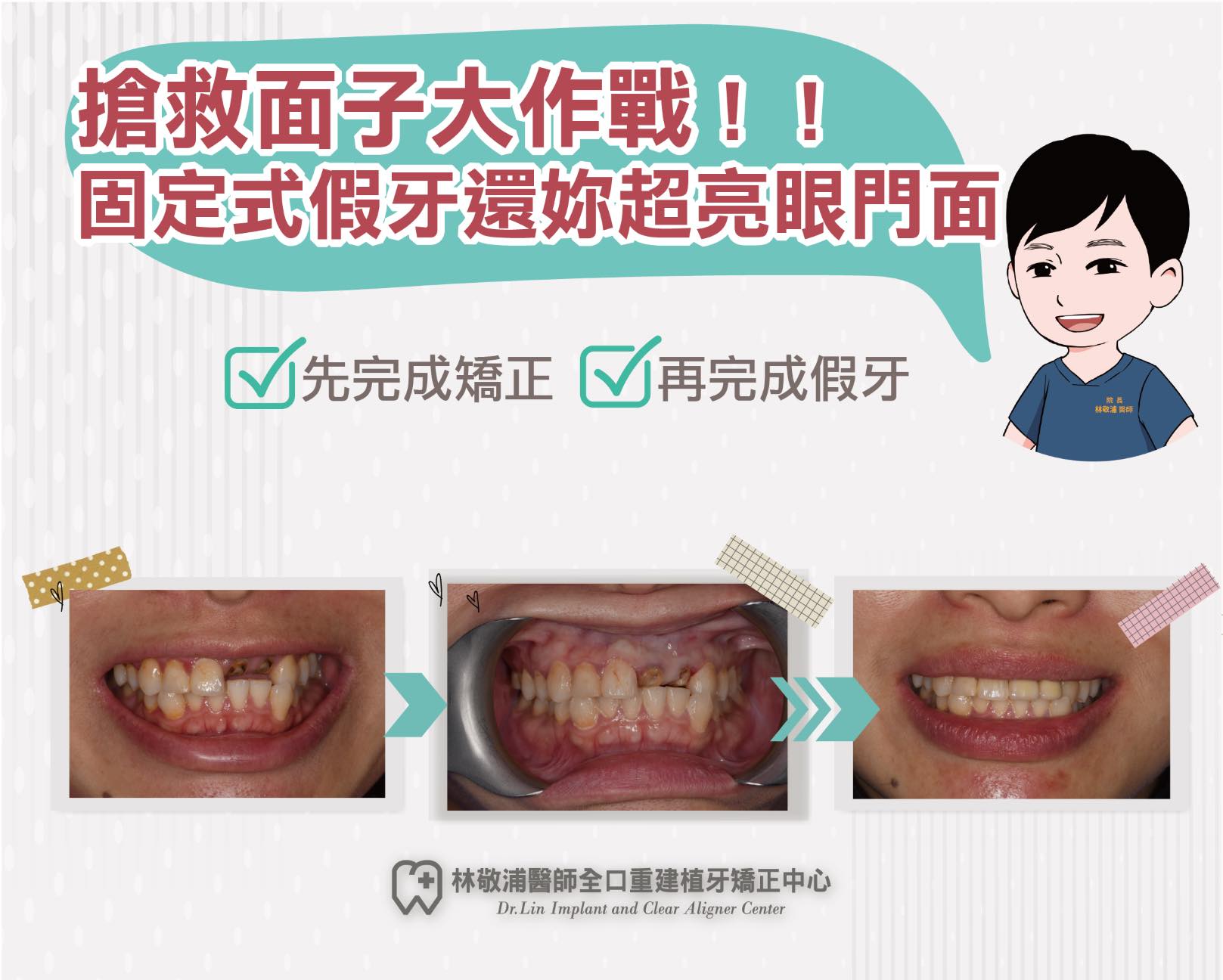 矯正｜固定式假牙