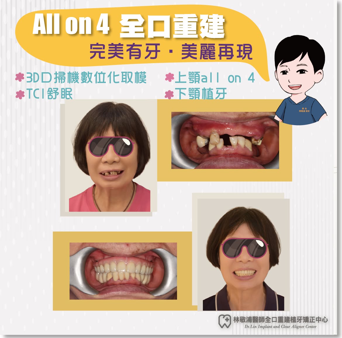 All on 4｜全口重建