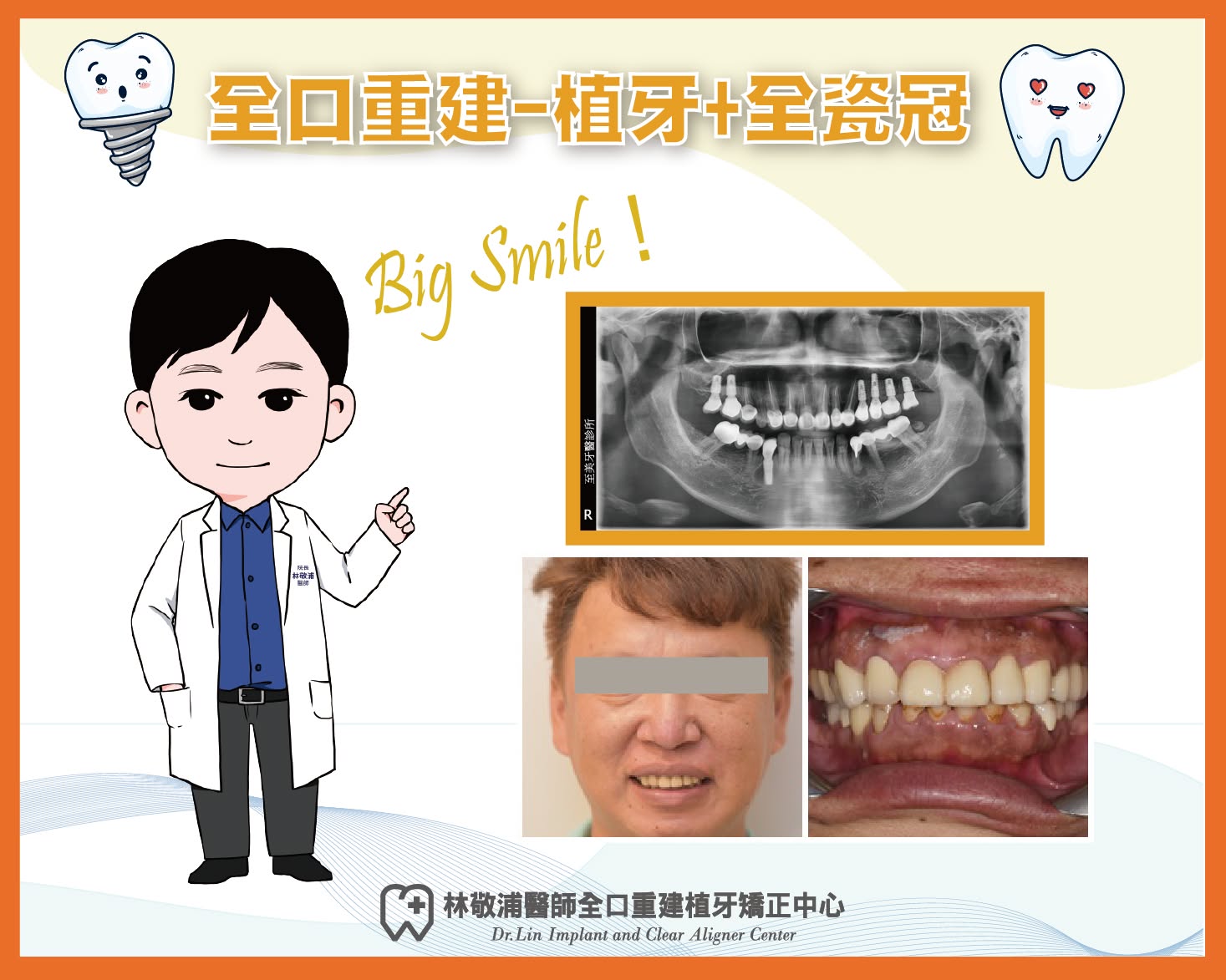 全口重建｜植牙+全瓷冠