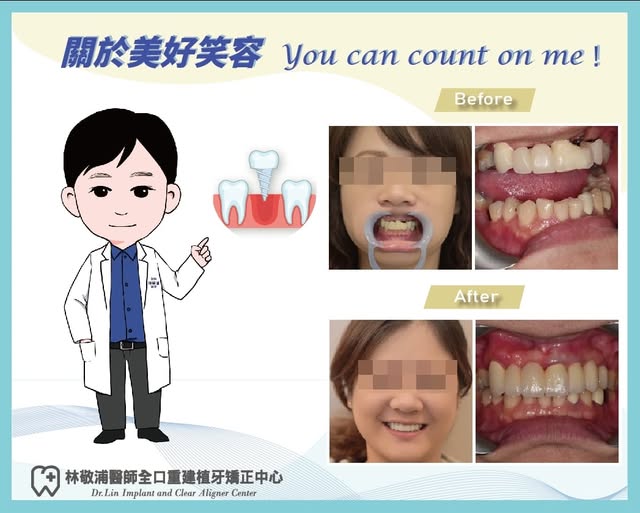 植牙與固定式假牙