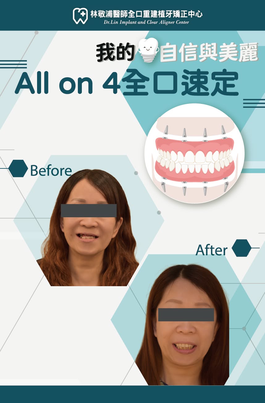 All on 4+舒眠植牙