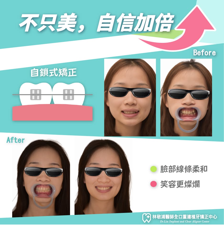 矯正｜自鎖式矯正