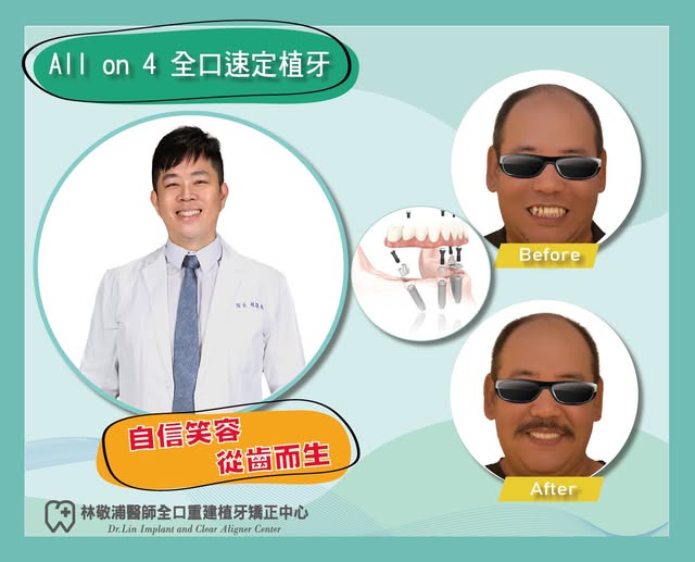 All on 4 一日全口重建